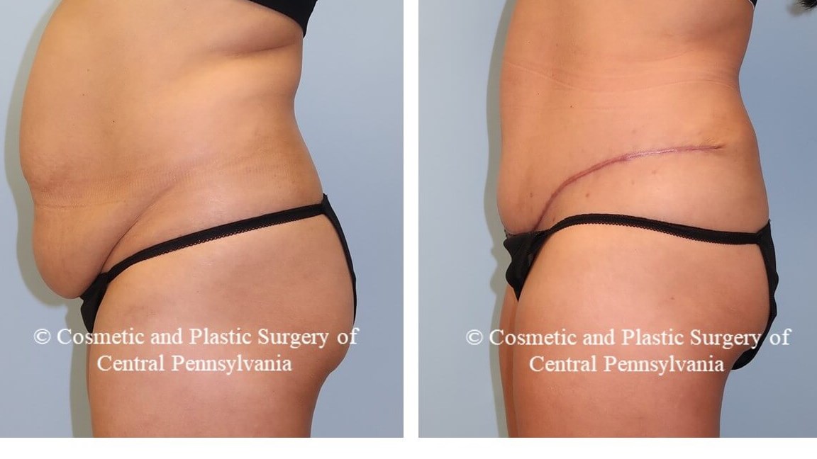 Tummy Tuck
